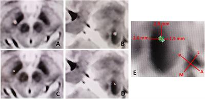 Response: Commentary: Using Directional Deep Brain Stimulation to Co-activate the Subthalamic Nucleus and Zona Incerta for Overlapping Essential Tremor/Parkinson's Disease Symptoms